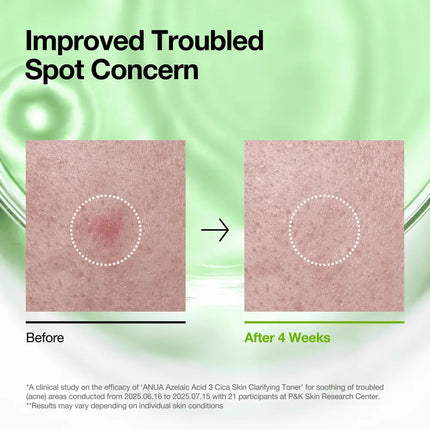 Anua Azelaic Acid 3 Cica Skin Clarifying Toner