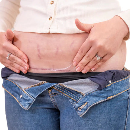 Booby Tape Tape Silicone Scar Patches