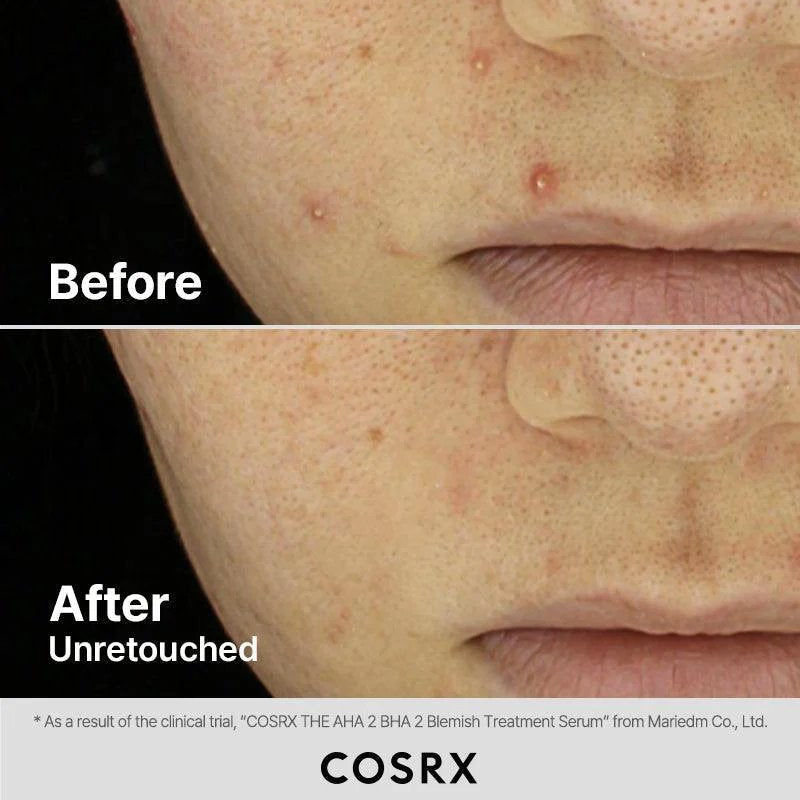 COSRX The AHA 2 BHA 2 Blemish Treatment Serum