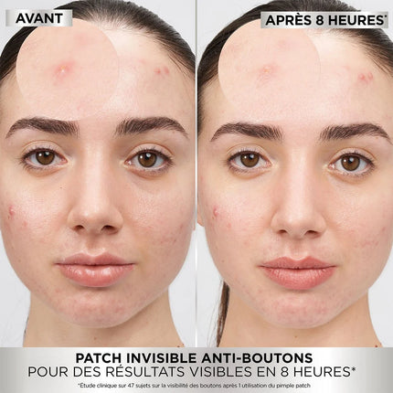 Garnier Skincare PureActive Pimple Patch