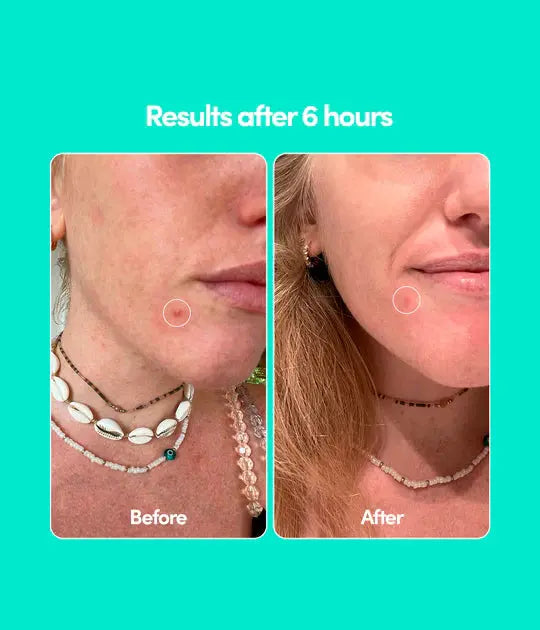 Merci Handy Pimple Patches