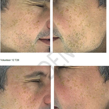 NERDS Hyperpigmentation Serum - 2% Alpha Arbutin + 1% Kojic Acid